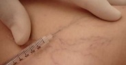 ESCLEROTERAPIA DE MICROVARIZES (APLICAÇÃO EM VASINHOS)