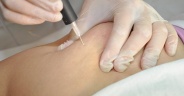 Carboxiterapia